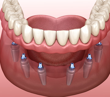 Illustration of an implant denture supported by six implants