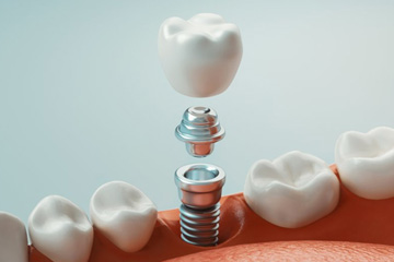 Digital image of a dental implant and it’s individual parts